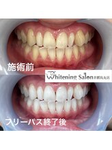 ホワイトニングサロン 京都烏丸店/ホワイトニング施術例