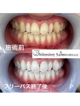 ホワイトニングサロン 京都烏丸店/ホワイトニング施術例