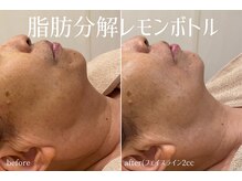 ハティア(hattia)/フェイスラインをくっきり作る♪