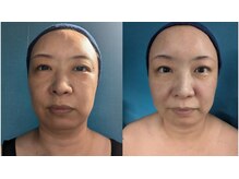 幸縁/小顔コルギ２回目