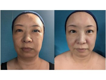 幸縁/小顔コルギ２回目