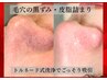 衝撃的汚れ！本気で悩む黒ずみ毛穴◎初回特別価格¥5,500◎