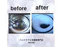 ネオ イヤー(Neo ear)の雰囲気（ 気になる耳アカもスッキリ ※afterは、引いて撮影しております）