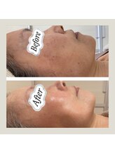 キラリス(Kilaris)/《効果絶大ハーブピーリング☆》