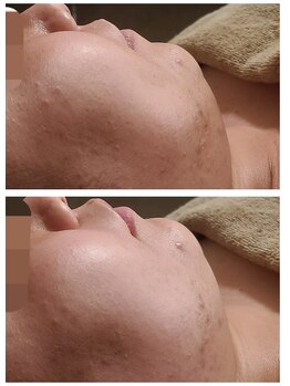 ウォーマル(warmaL)/小顔矯正/頬の厚み、顎周り◎