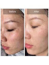 ルミヌーズ(Lumineuse)/白玉ピーリング