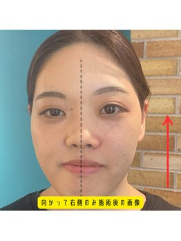 ネクスフィット(Nexfit)/小顔矯正フェイスリフトの効果