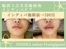 フランジパニ