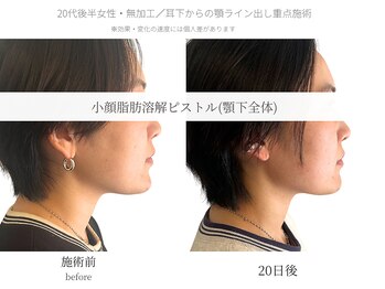 サボラミ(sabor A Mi)/顎下全体　小顔脂肪分解ピストル