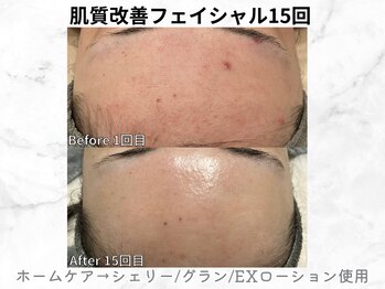 リライン(ReLine)/【リアボーテフェイシャル15回】