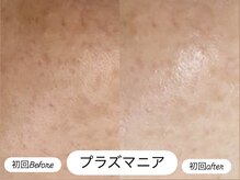 グラースア(grace a)の雰囲気（ダウンタイムなし//土台から整う。シミ薄く。ハリ。なめらか。）