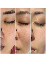 リンク(LiNK)/気になる毛穴ケア