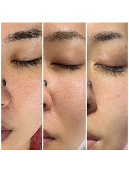 リンク(LiNK)/気になる毛穴ケア