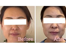 小顔矯正サロン ブルーム/施術1回のビフォーアフター