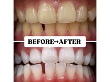ホワイトニングサロン 豊中/Before&After美白ホワイトニング