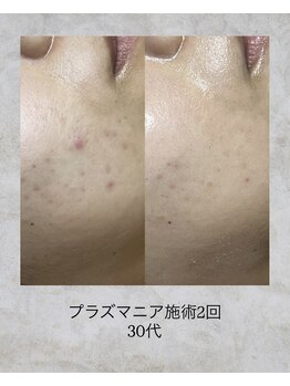 コンクパール(CONCH PEARL.)/プラズマニア