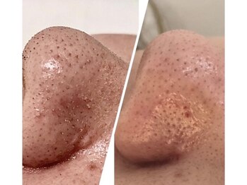 ココ(coco)/話題沸騰!ハイドラフェイシャル