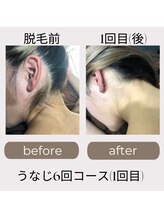 レア(LEA)/【レディース】うなじ脱毛