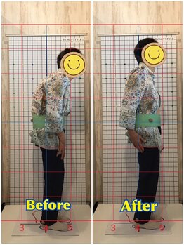 くすの樹接骨院 整体院 吉野ヶ里院/整体/骨盤矯正ビフォーアフター