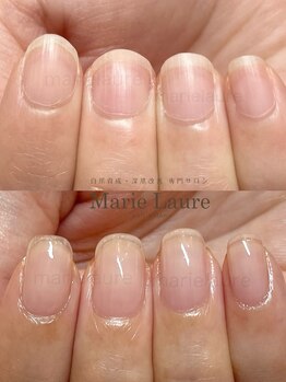 マリーロール 梅田店(Marie Laure)/深爪矯正/自爪育成/自爪風