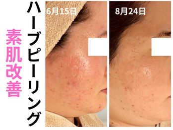 エリン(ERIN)/毛穴徹底洗浄×ハーブピーリング