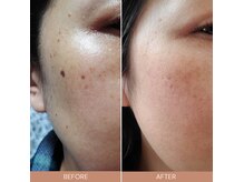 リバージュサロン(RIVAGE salon)の雰囲気（【シミケア導入！】ずっと気になっていたシミが薄くなるを実感！）