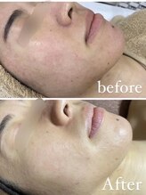 レイ(Lei)/ハーブリプロでお肌質改善