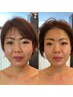 【6月限定】毛穴開き・ムクミすべてスッキリ解消　艶玉肌コース　1回8900円