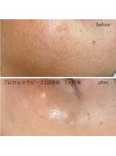 レア(le'a)/肌質改善