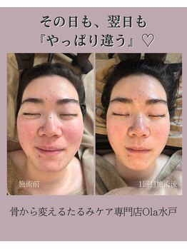 オラ(Ola)/30代/1回目施術後