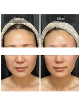 ジュエル シズオカ(JEWEL Shizuoka)/セルラムBefore After１回