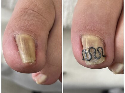 西宮巻き爪矯正センターの写真