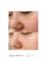 リコア(Likoa)/初回のbefore afterです