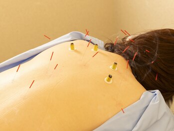 一二三鍼灸マッサージ治療院の写真/鍼灸で首・肩のつらさをサポート◎完全予約制の女性向けサロンで、オイルケアで綺麗になりたいあなたへ♪