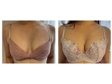 ビービリア(B.villea)/バストアップ施術3回