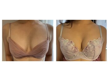 ビービリア(B.villea)/バストアップ施術3回