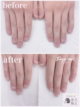 ティアラネイル 宇都宮/リプロネイル深爪矯正コース