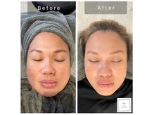 サロン ド パーフェクション(Salon de Perfection)/小顔リフト