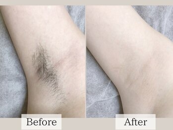 アルゴ 熊本光の森店(ALGO)/【脇】人気のわき脱毛