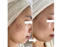 シェノンの雰囲気（【ニキビケア卒業×再発防止】繰り返すトラブルを根本改善へ）