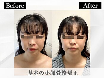 ポーベルポー(Peau Belle poe)/基本の小顔骨格矯正｜3回目