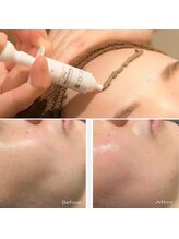 ブライズ(BRISE)/ＶＯＳスキントリートメント