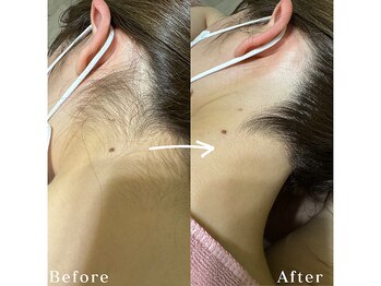 エルム 京都駅前店(elm)/＊うなじ脱毛＊