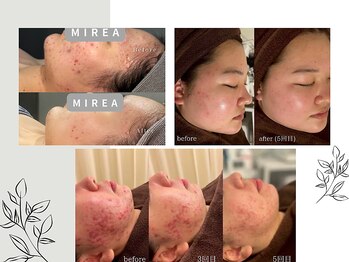 ミレア 恵比寿(MIREA)の写真/皮膚科の塗り薬でも改善されないニキビ肌に徹底アプローチ！内側から輝くような美しい素肌へ導きます◎
