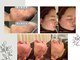 ミレア 恵比寿(MIREA)の写真/皮膚科の塗り薬でも改善されないニキビ肌に徹底アプローチ！内側から輝くような美しい素肌へ導きます◎