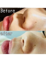 サロンM 豊田店/水素の力でごっそり毛穴洗浄