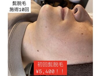 ヴァリエ(Varier)/髭脱毛