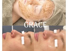 グレース(GRACE)/ツヤ肌！ハーブピーリング