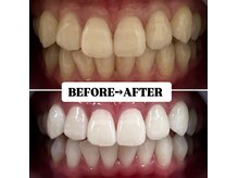 ホワイトニングサロン 豊中/Before&After美白ホワイトニング