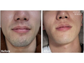 アットイカウ 下北沢(at ikaw)/全顔スッキリ脱毛 Before/After